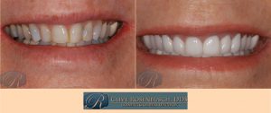 A before and after picture of teeth whitening