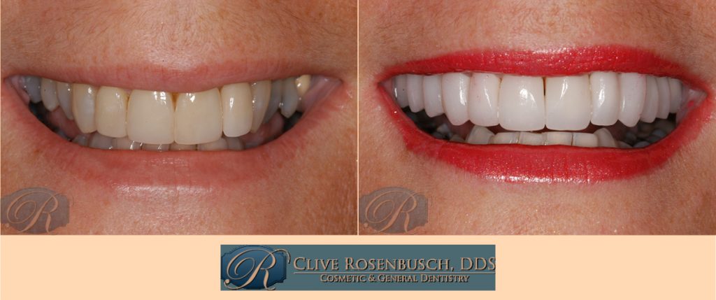 A before and after picture of the teeth whitening process.