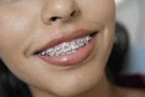 Braces on a smiling person's teeth.