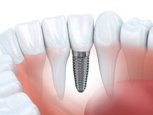 Dental implant restorations in progress in Boca Raton, FL