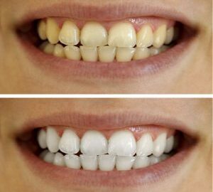 Before and after teeth whitening comparison.