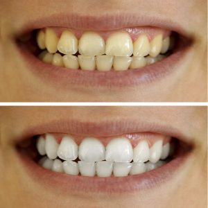 A before and after picture of teeth whitening.